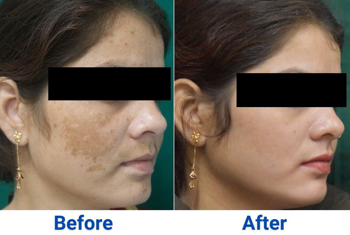 After treatment, case 1
