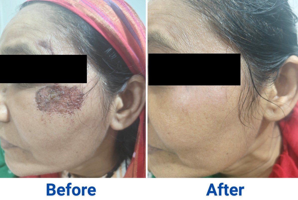 After treatment, case 4