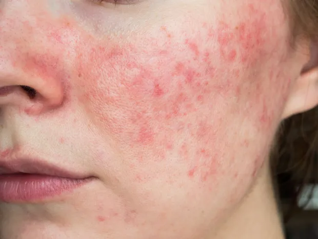 Skin Treatments